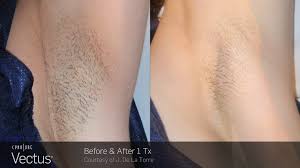 We provide detail information and before & after photos of laser hair removal in tacoma. High Volume Hair Removal Vectus Laser Cynosure