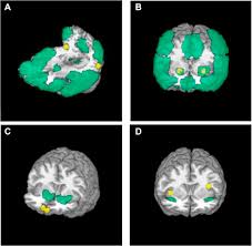 Check spelling or type a new query. Functional Connectivity Between Extrastriate Body Area And Default Mode Network Predicts Depersonalization Symptoms In Major Depression Findings From An A Priori Specified Multinetwork Comparison Biological Psychiatry Cognitive Neuroscience And