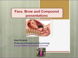 Image result for Brow Presentation