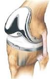 Image result for icd-10 code for right tka