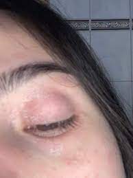 Weisse Trockene Haut Um Auge Gesundheit Und Medizin Beauty Augen