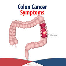 Image result for Constipation in Cancer