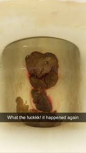 Image result for blood in stool human poop