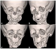 © 2003 by saunders, an imprint of elsevier, inc. Cherubism In A 4 Year Old Boy Managed With Tumor Curettage Mandibular Osteotomies And Repositioning