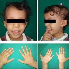 Clinical diagnostic flowchart for patients with a Prader-Willi-like or...