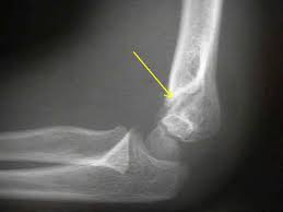 Avulsion fracture of the lateral condyle that results from the pull of the common extensor musculature. Frx Of The Lateral Condyle In Children Wheeless Textbook Of Orthopaedics