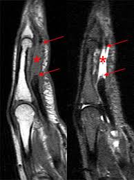 Anatomy and physiology of this flexor tendon gliding and reflection system at the level of the digital sheet are exposed. Flexor Tendon Injuries Radsource