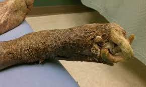 Image result for Onychogryphosis feet