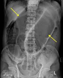 Image result for Sigmoid Volvulus