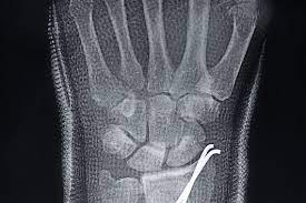 Pada bagian batang tanaman ini memiliki getah berwarna putih yang. Kirschner Atau K Wires Pin Bone Pembedahan