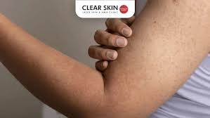 Image result for Keratosis pilaris