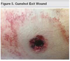 Velocity is classified as low (<1000 fps), medium (1000 to 2000 fps), and high (>2000 fps). Gunshot Wounds Ballistic Trauma In The Emergency Department