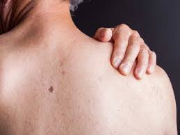 Many people — between 40 and 90 percent — experience. Hiv Rash What Does It Look Like And How Is It Treated