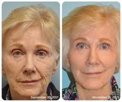 flysmus™ BotoxLUX Anti Aging Serum