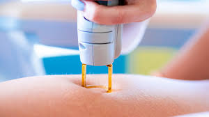 Laser hair removal treatment works by targeting the melanin found in dark hair follicles with pulses of light. Laser Hair Removal At Home 7 Of The Best Devices