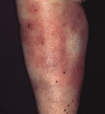Image result for Panniculitis