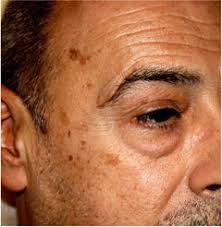 4 Natural Remedies To Remove Age Spots