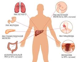 Metastazy V Pecheni Simptomy Lechenie Metastaz V Pecheni Skolko Zhivut S Metastazami Pecheni Mts Pecheni
