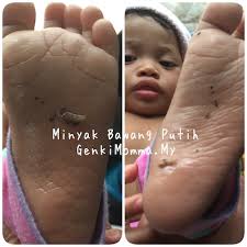 6 jenis batuk pada bayi dan cara mengatasinya hello sehat. Cara Buat Minyak Bawang Putih Untuk Bayi Selesema Berkahak Genkimomma My
