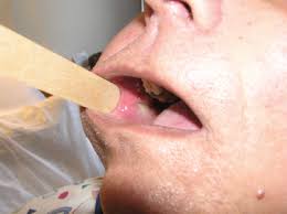 Image result for Sialoadenitis