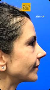7 week post op result following septo-rhinoplasty. Patient goals:  straighten nose, natural & elegant profile ✅, 🥼 Alex Mesbahi, MD FACS, 🏥  National Center for Plastic Surgery, ⏳ 2 hours, ❤️‍🩹 ...