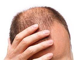 Females with thin hairs on top usually try to carry those style which helps their hair look more thick and healthy. Do Vitamins For Thicker Hair Work