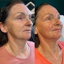 5 treatments of cold plasma alternating the advanced skin tightening facial  and needle free facial. Client is sitting up in both pictures, the results  speak for themselves 😍. #coldplasma #skin #leesburg #results #