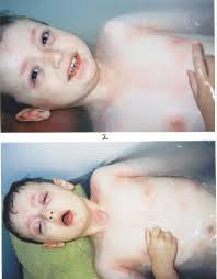 Hives And A Skin Rash Nightmare