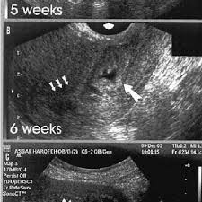 We did not find results for: Ultrasound Follow Up At 5 6 And 7 Weeks Gestation At 5 And 6 Weeks Download Scientific Diagram