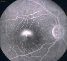Many blood vessels feed the retina. Damsdelhi Ophthalmology Update Important Topic Central Facebook