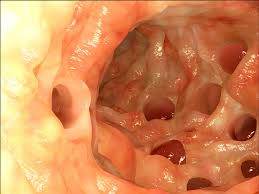 Image result for Diverticulitis
