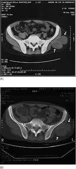 We did not find results for: Hydatid Cysts In Muscle A Modified Percutaneous Treatment Approach International Journal Of Infectious Diseases