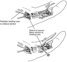 Flexor tendon injuries are traumatic injuries to the flexor digitorum superficialis and flexor digitorum profundus tendons that can be caused by laceration or trauma. Flexor Tendons Anatomy And Surgical Approaches Hand Clinics