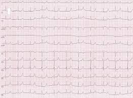 Long Qt Syndrom Fokus Ekg