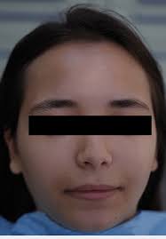 Clinical aspect of the face 48 hours after the third session.