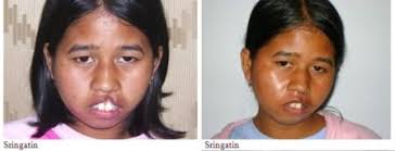 Operasi bibir sumbing di RSK Budi Rahayu Blitar ditangani oleh para dokter spesialis bedah yang telah berpengalaman. - gb1