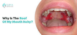 Image result for Physical injury red spots roof of mouth