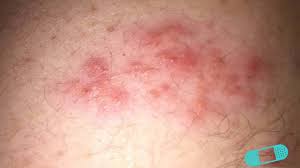 Symptoms typically start with pain along the affected. Herpes Zoster Shingles Online Dermatology