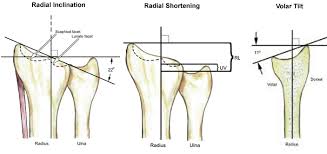 Distal Radius Fractures Trauma Orthobullets