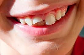 Golpe En Los Dientes Que Hacer Ante Un Traumatismo Dental