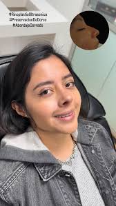 Unboxing 1 semana después de Rinoplastia Ultrasónica de mi linda paciente.  En su caso en particular decidí realizarle una técnica de preservación de  dorso al mismo tiempo que corregimos su desviación ...