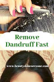 The acidity of the vinegar is believed to help stimulate the shedding of dead skin cells on the scalp. How To Remove Dandruff Fast Remove Dandruff How To Remove Dandruff Hair Mask For Dandruff