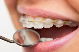 It's caused by a breakdown of the minerals on your teeth beneath the brackets. Nikaeen Orthodontist Los Angeles Braces And Invisalign