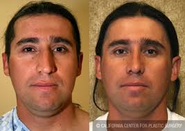 Maybe you would like to learn more about one of these? Patient 6405 Male Rhinoplasty Before And After Photos Beverly Hills Plastic Surgery Gallery Los Angeles Ca Dr Sean Younai