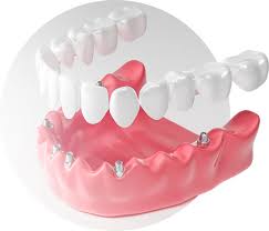 імплантація зубів