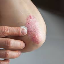 Image result for psoriasis