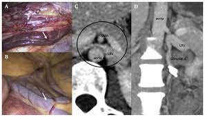 This article or area is currently under construction and may only be partially complete. Combined Nutcracker And Ehlers Danlos Syndromes A Case Report Ejves Vascular Forum