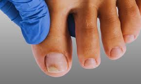 Image result for mykoza nehtů