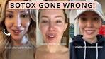 I Got Botched Botox | Before and After Bad Botox - YouTube