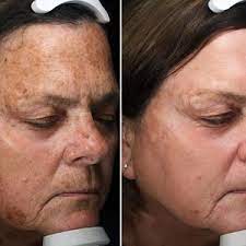 Using controlled flashes of light to penetrate the skin, bbl damages the hair follicle to prevent regrowth. Broadband Light Bbl Reviews Was It Worth It Realself